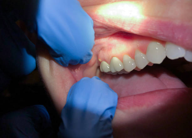 Best Lost Filling or Crown Replacement in Roselawn, IN
